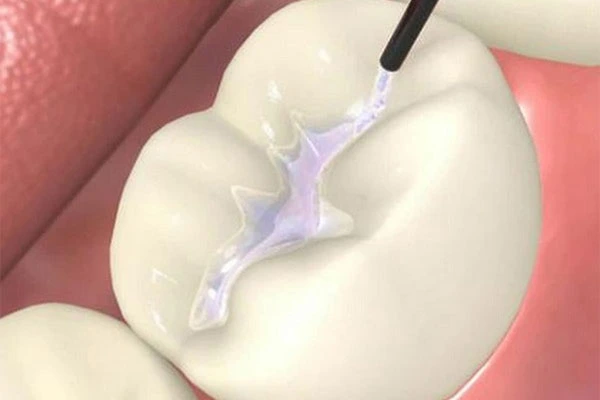 Cavity Filling Treatment